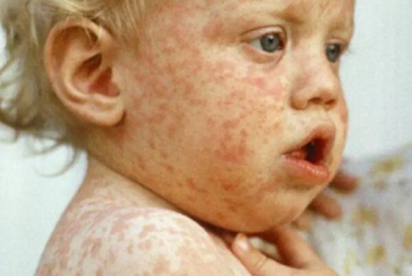 Ucrânia: sarampo aumenta onde EUA mantém laboratórios biológicos